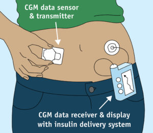 CGM - Continuous Glucose Monitor